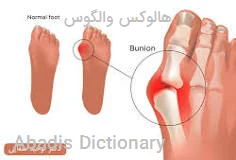 هالوکس والگوس